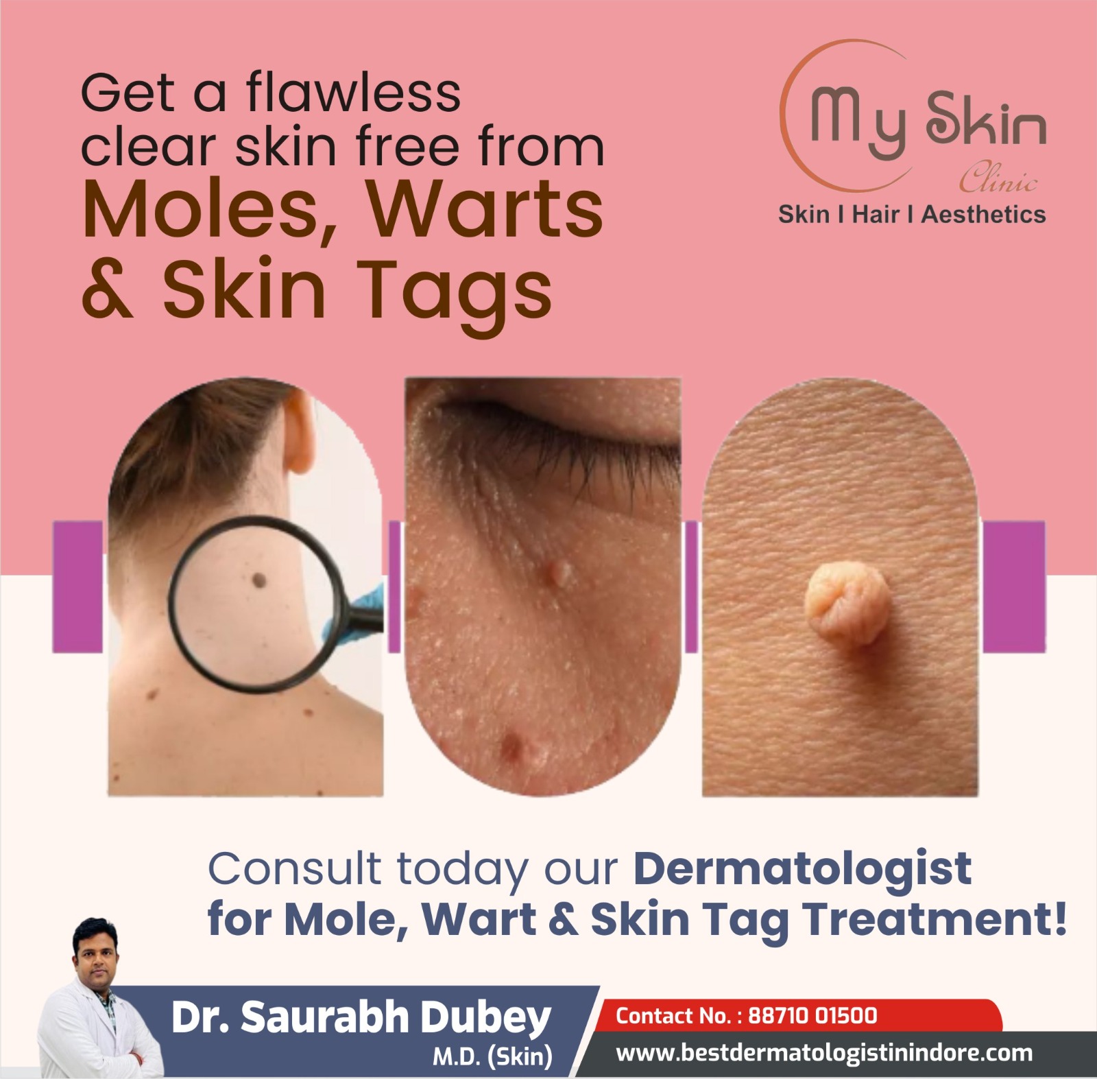 Best Dermatologist For Mole And Skin Tags Removal Treatment In Indore